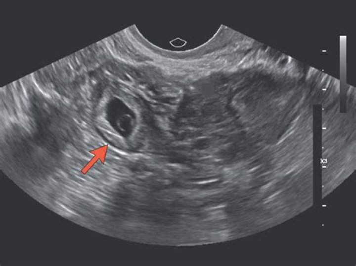Would a tubal pregnancy show up on an ultrasound?