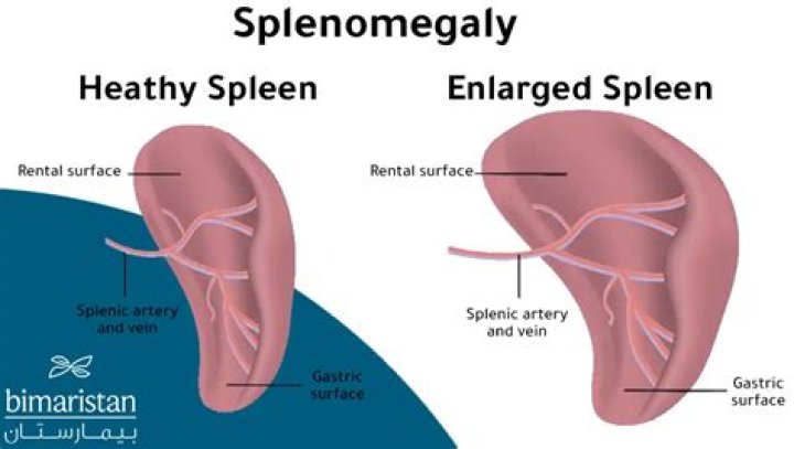 Would enlarged spleen cause pain?