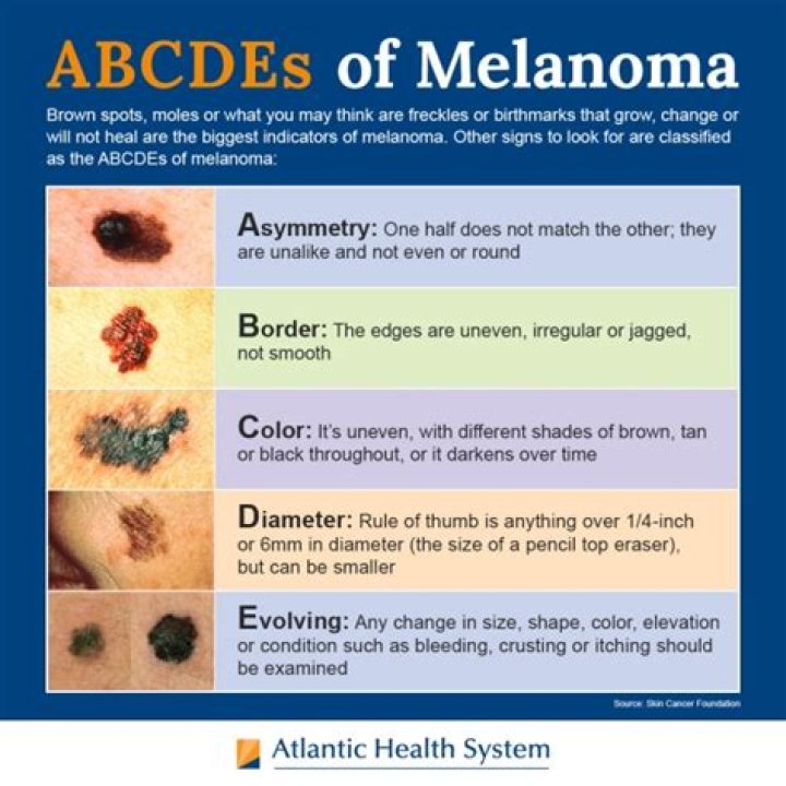 Would melanoma show up on a ct scan?